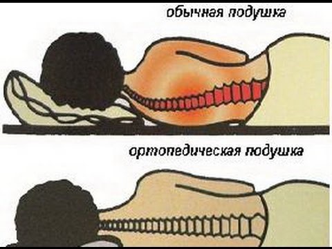 Шейный остеохондроз: подбираем ортопедическую подушку